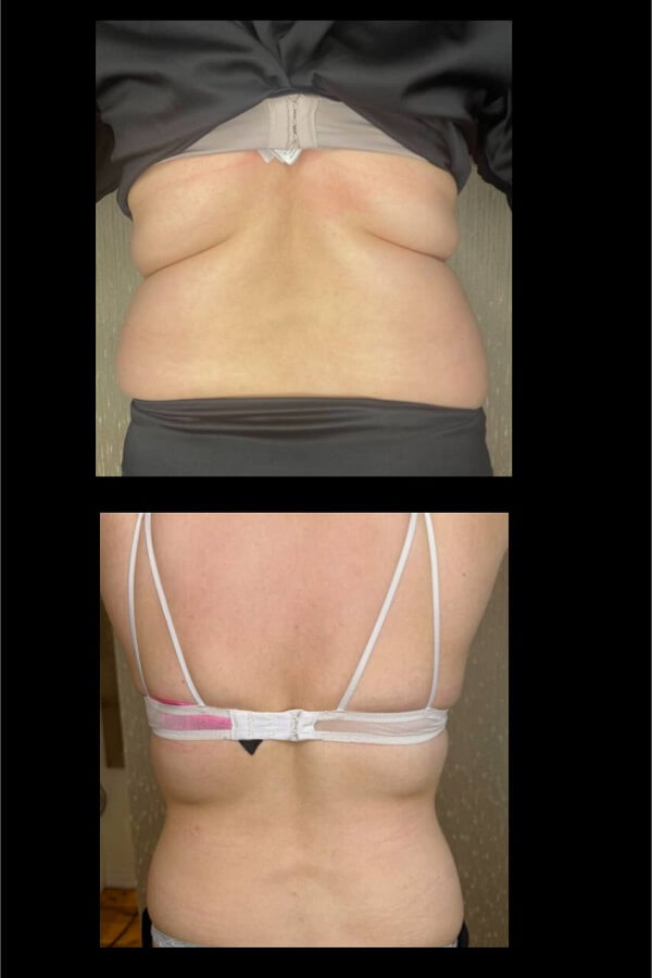 Lipolysis fat dissolving injections-Toronto