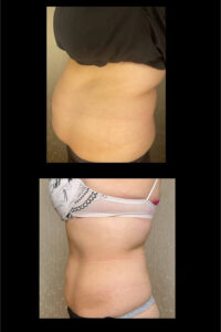 Body FX Slimming Treatment