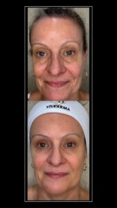 Lumecca Treatment