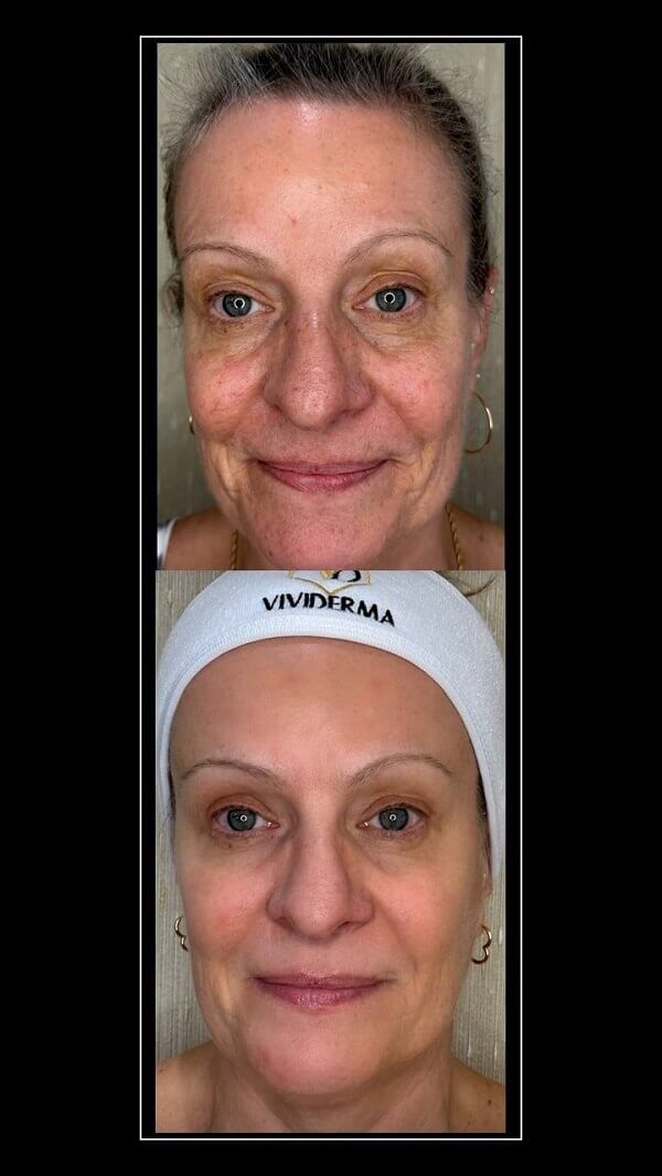 Lumecca Treatment
