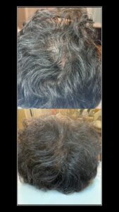 PRP Treatment Toronto