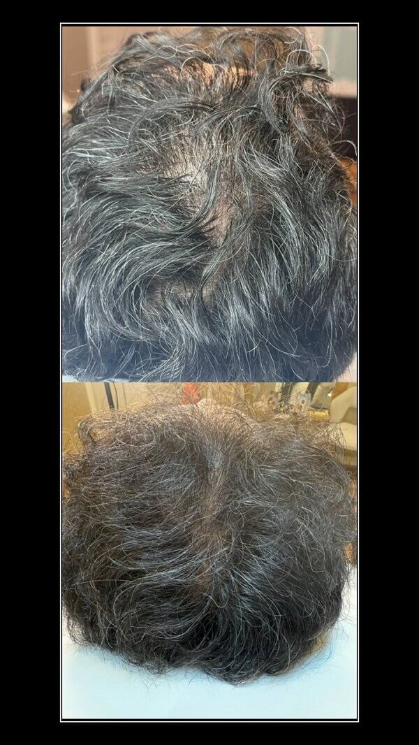 PRP Treatment Toronto
