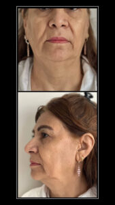 Skin Booster