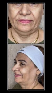 Skin Booster