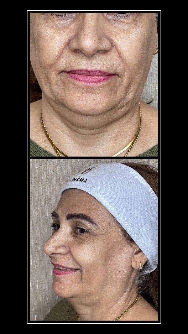 Skin Booster