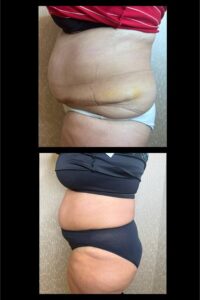 Weight Loss Medications-Toronto