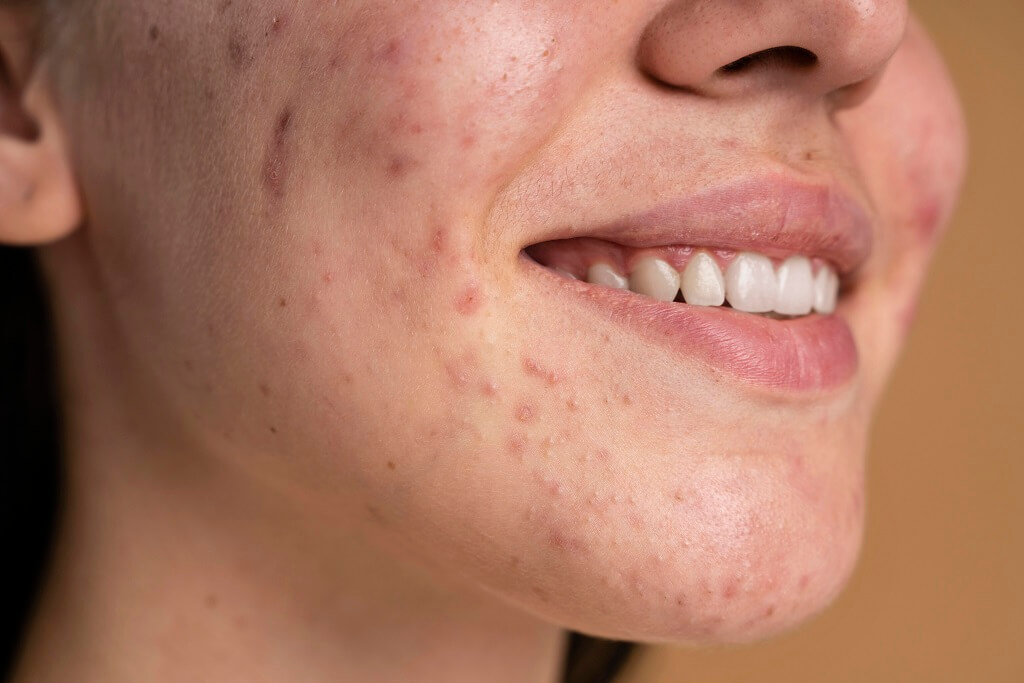 Morpheus8 for Acne Scars