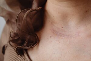 Close-up image of a neck scar with surrounding delicate brown fabric, highlighting skin texture and detail.