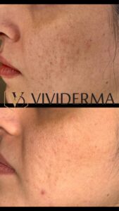 ACNE Scar Removal Toronto