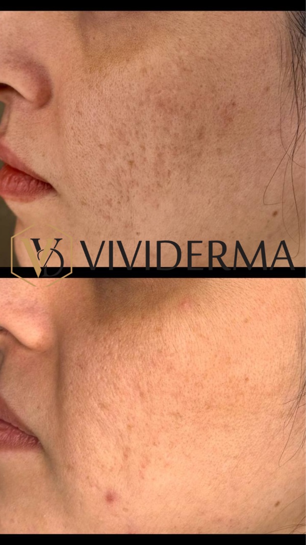 ACNE Scar Removal Toronto