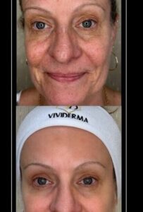 Non Surgical Blepharoplasty