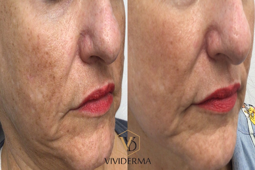 Skin booster injectable treatment providing deep hydration and improved skin texture in Toronto.