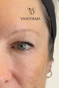Non Surgical Blepharoplasty