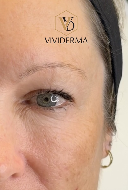 Non Surgical Blepharoplasty