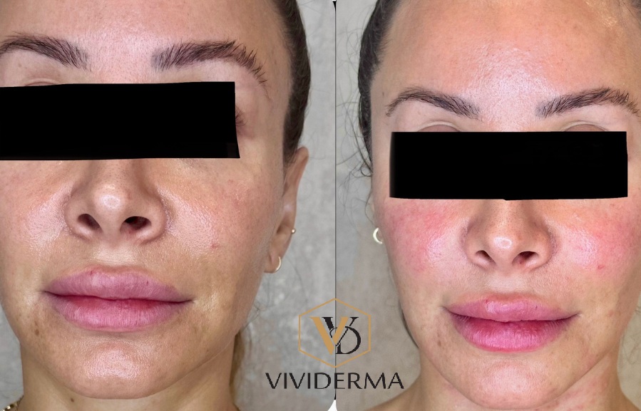 Skin booster injectable treatment providing deep hydration and improved skin texture in Toronto.