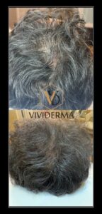PRP hair restoration treatment.
