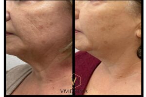 Skin booster injectable treatment providing deep hydration and improved skin texture in Toronto.