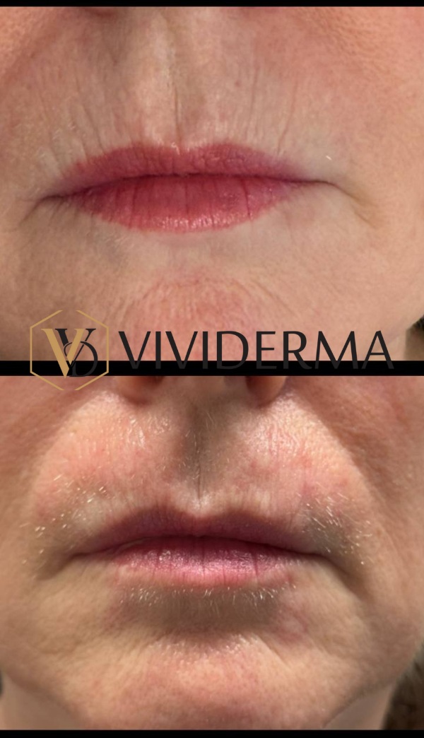 Wrinkle Removal Treatments