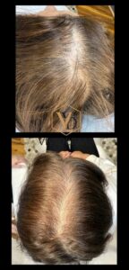 PRP hair restoration treatment.