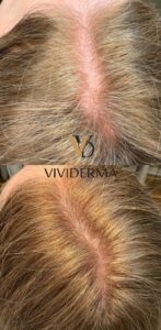 PRP hair restoration treatment.