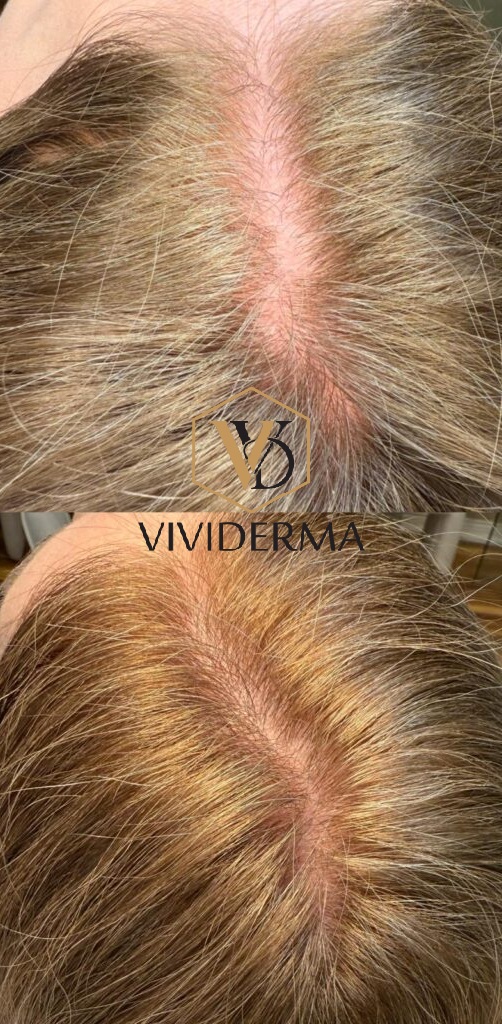 PRP hair restoration treatment.