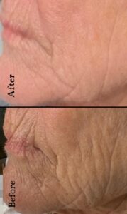 Wrinkle Removal Treatments