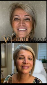 Wrinkle Removal Treatments