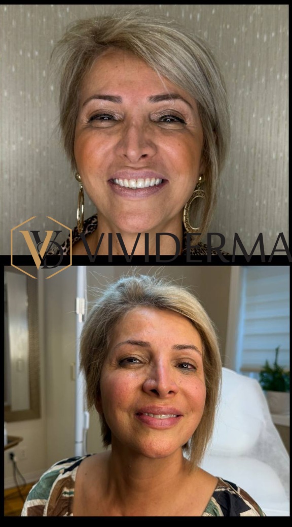 Wrinkle Removal Treatments