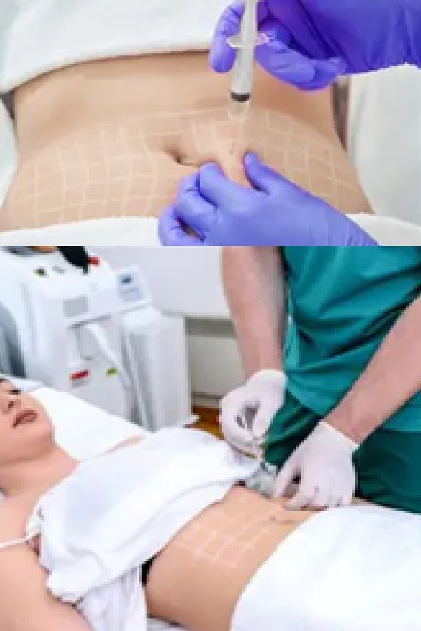 What Are Lipolysis Injections, Their Benefits and Risks