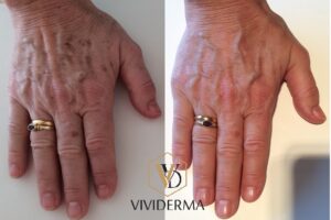 Hand Rejuvenation Toronto-933 Mt Pleasant Rd, Toronto, ON M4P 2L7