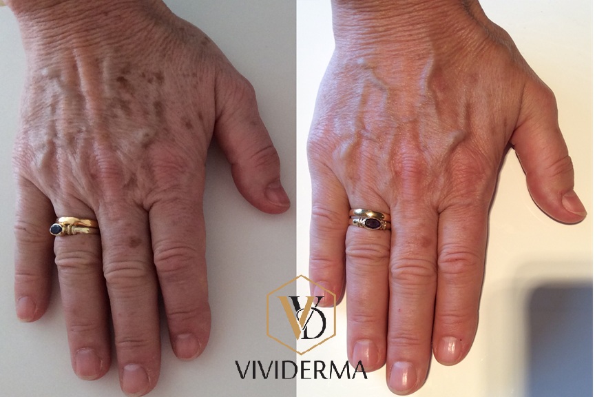 Hand Rejuvenation Toronto-933 Mt Pleasant Rd, Toronto, ON M4P 2L7