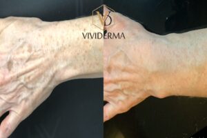 Hand rejuvenation treatment 