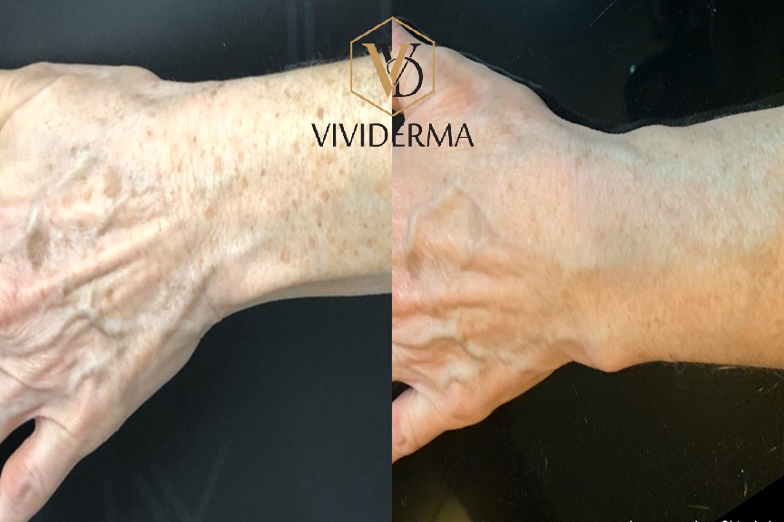 Hand rejuvenation treatment 
