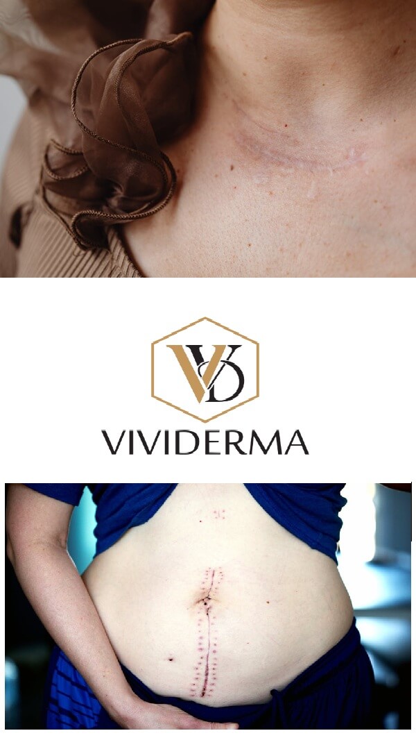 Scar removal from Surgery