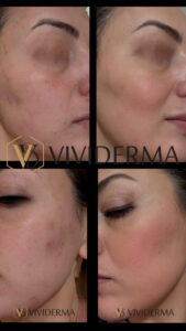 ACNE Scar Removal Toronto