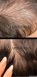 PRP CELL REVIVE restoration treatment.