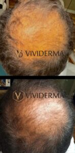PRP CELL REVIVE restoration treatment.