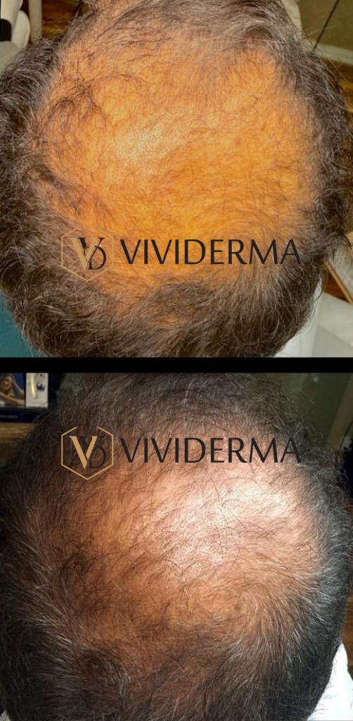 PRP CELL REVIVE restoration treatment.