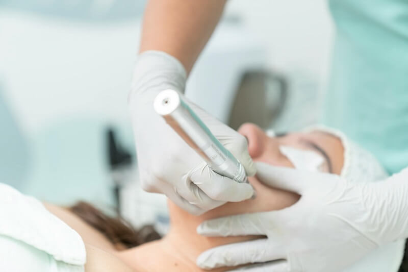 How Long to Wait Between Microneedling Sessions