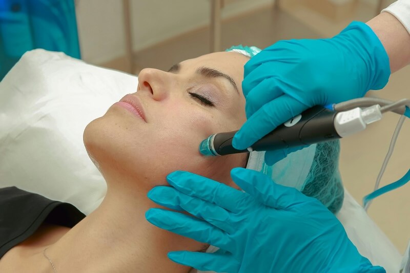 Microneedling Results Timeline When Will You See Results